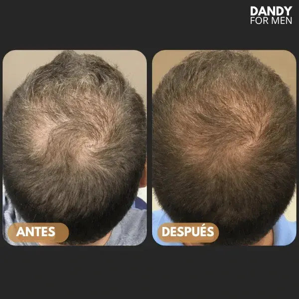 Dandy For Men™ || Shampoo Activador de Raíces || Lanzamiento 50% OFF