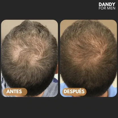 Dandy For Men™ || Shampoo Activador de Raíces || Lanzamiento 50% OFF