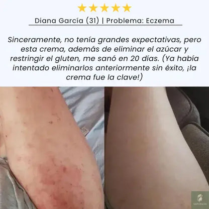 Milagro del Océano - Solución Natural para el Eczema